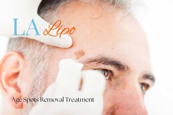 What Are the Most Effective Treatments for Age Spots Romford?