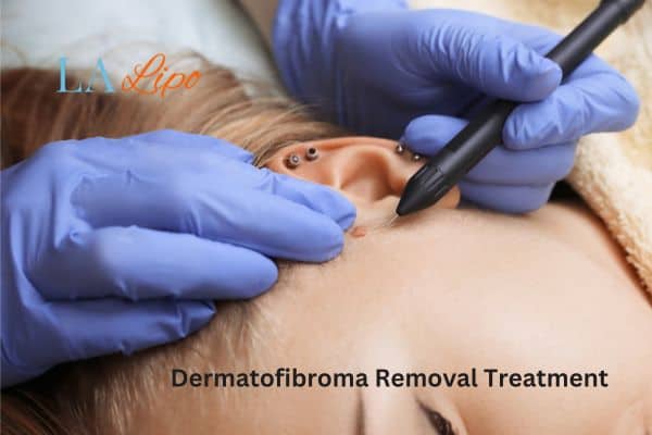 Dermatofibroma Removal Treatment Romford