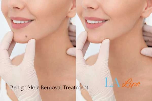 woman's before and after mole removal Romford results