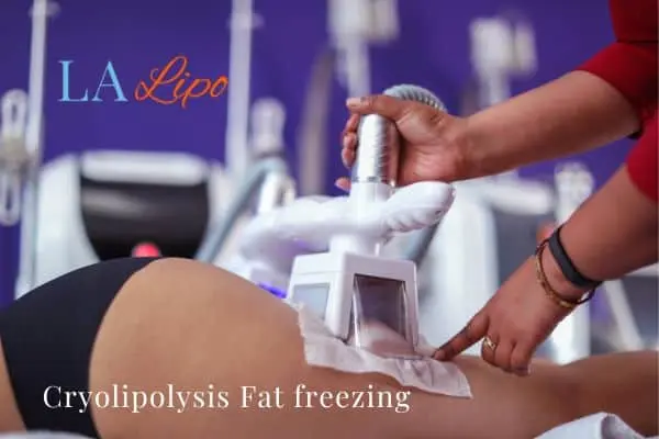 women getting fat freezing Romford