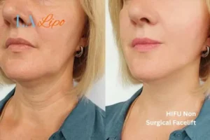 hi-fu for wrinkles Romford before and after results
