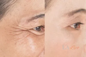 Before and after results of woman - HI-fu wrinkles reduction treatment Romford