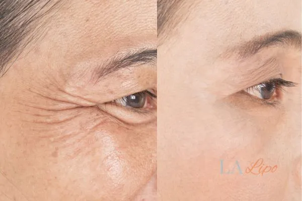 Before and after results of woman - HI-fu wrinkles reduction treatment Romford
