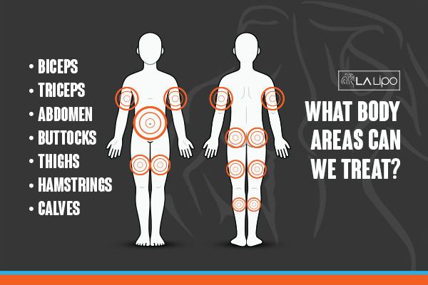Graphic to show areas you can have LA-EMS Body Sculpting Romford treatment.