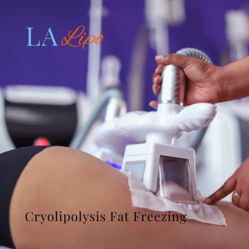 fat freezing - Cryolipolysis Romford