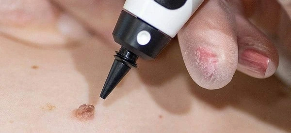 skin tag removal using cryopen Romford