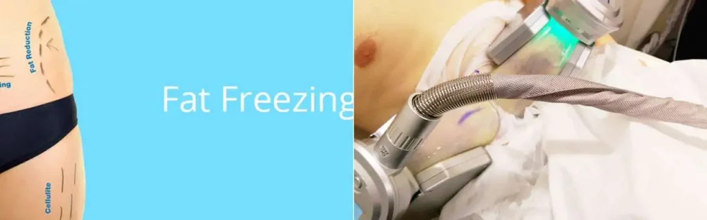 Fat freezing Romford on multiple areas of the body