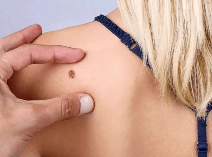 woman having mole removal Romford consultation before treatment.