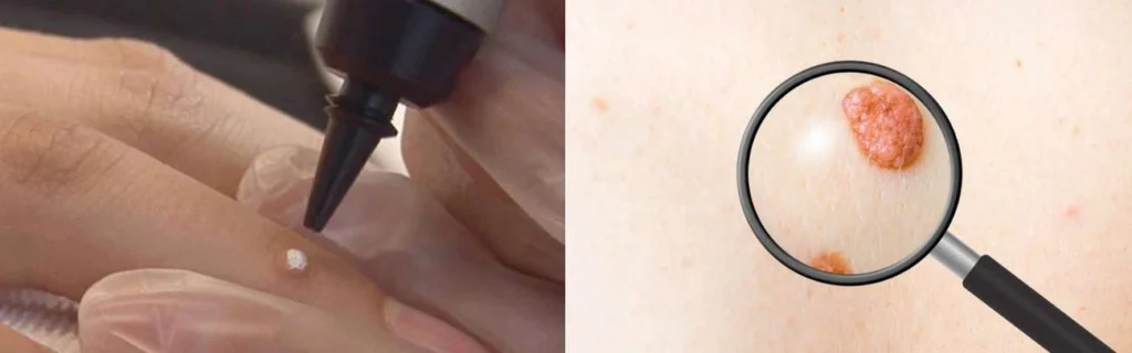 CryoPen practitioner Romford assessing a benign mole before treatment
