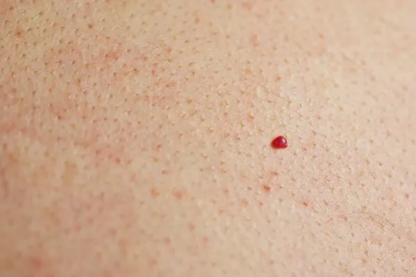 close up of a cherry angioma Romford