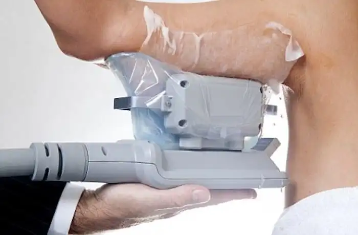 Picture of fat freezing Romford on the upper arms.
