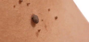 image of a skin tag Romford