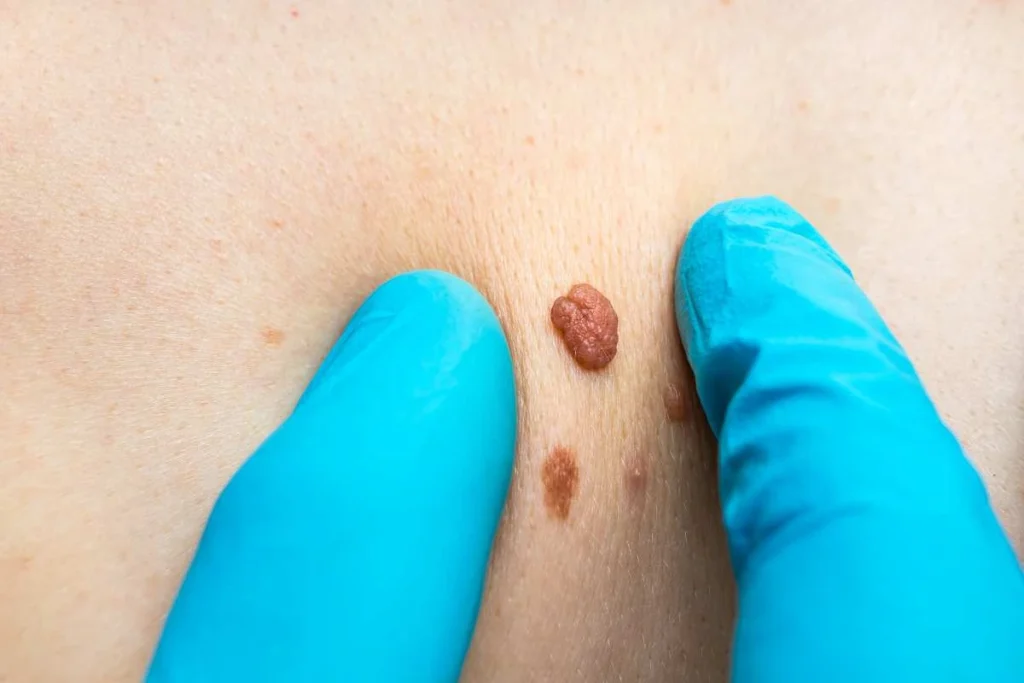 Consultant examining a skin tag Romford