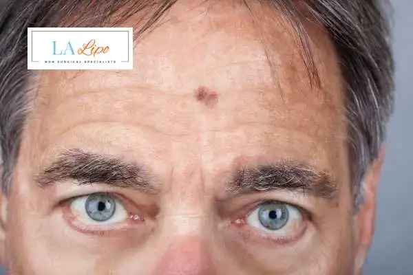 Solar Lentigo Removal Romford image of man with mark on his forehead