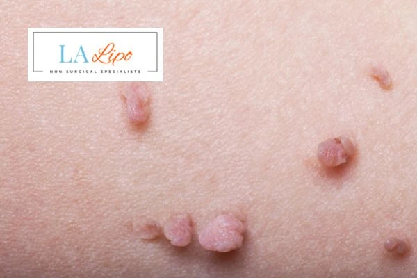 Does cryopen skin tag removal Romford hurt? Find out now call our team today!
