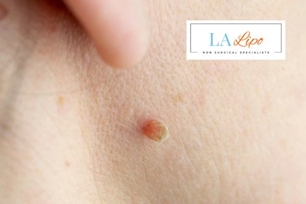Book skin tag removal Romford today speak to our team now!