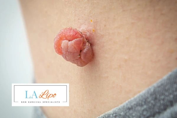 Interested in skin tag removal Romford? Concerned about the pain? Find out more today!