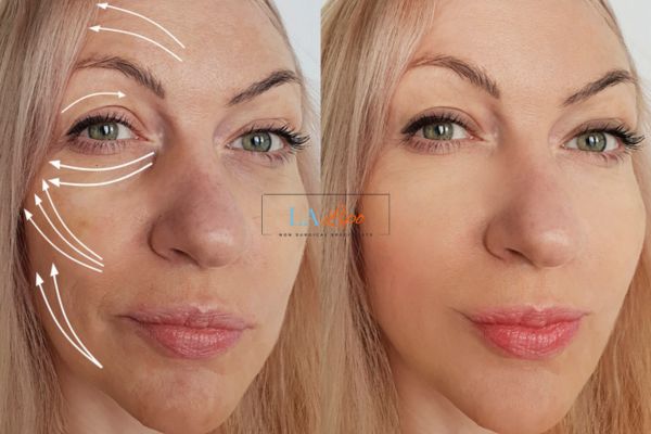 Morpheus 8 results Romford face lift.