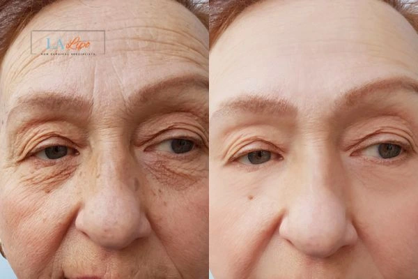 The powerful benefits of Morpheus8 Treatment Romford - Call Our team today!
