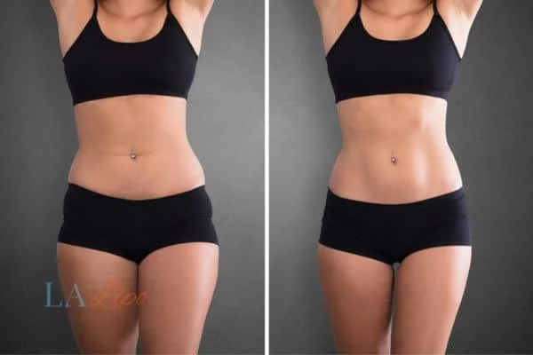 before and after results of non-surgical treatment to help a woman's body image and mental health Romford