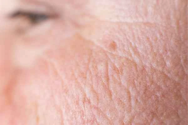 close up picture of a woman's face showing an age spot Romford