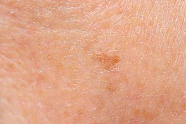 close up picture of age spots Romford