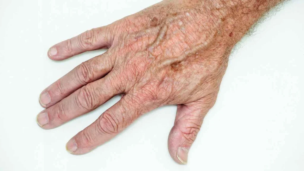 Male hand showing age spot Romford