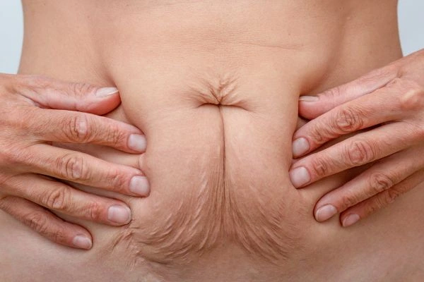 Image of a woman's stomach with loose skin - example of skin tightening Romford options