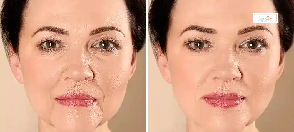 How Long Does It Take to See Results and How Long Do They Last Romford?